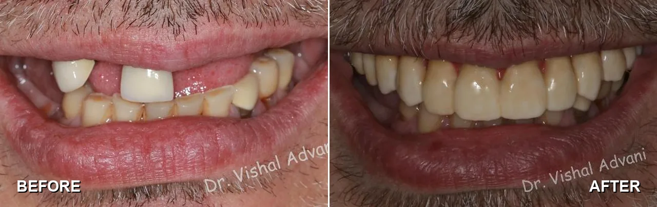 Before and after: missing upper teeth replaced with All-on-5 implants