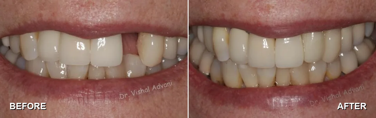 Before and after: a broken front tooth replaced with a dental implant