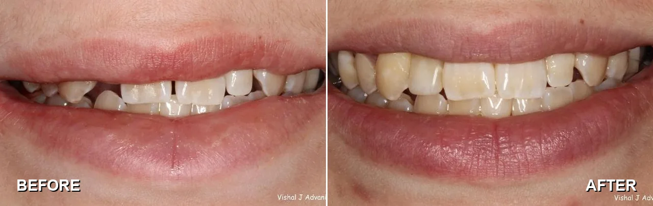 Before and after: a missing adult tooth replaced with an implant