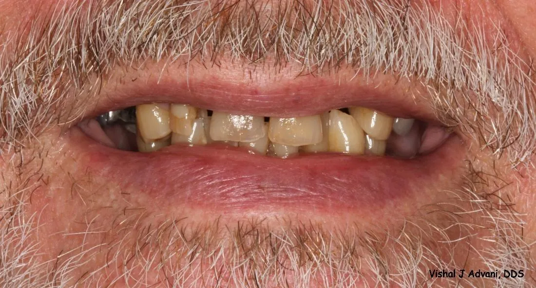 Before: All-Ceramic Bridge & Tooth-Colored Filling
