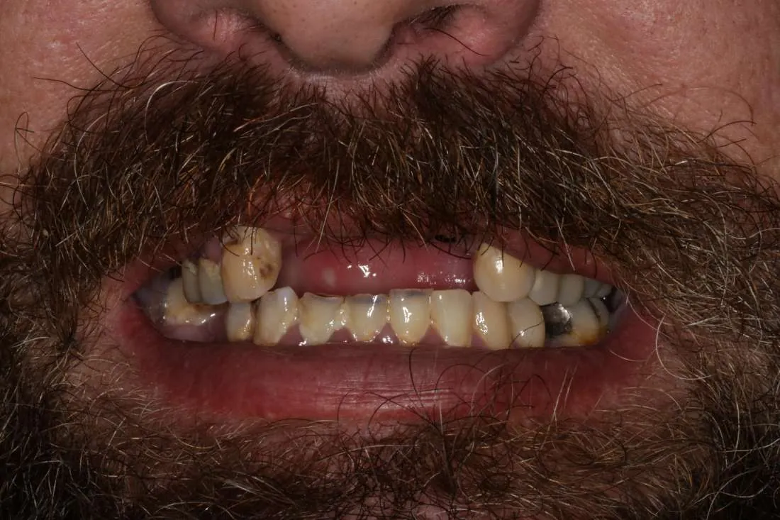 Before: All-on-4 Transformation