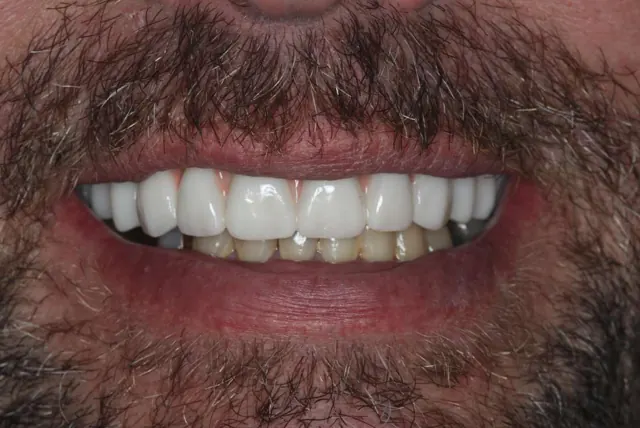 After: All-on-4 Transformation