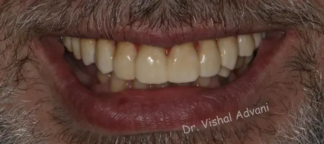 After: All-on-5 for Missing Upper Teeth