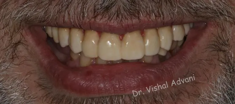 After: All-on-5 for Missing Upper Teeth