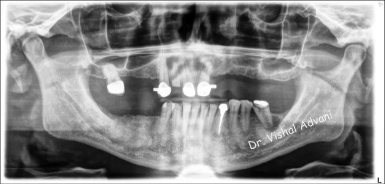 Before: All-on-5 for Missing Upper Teeth