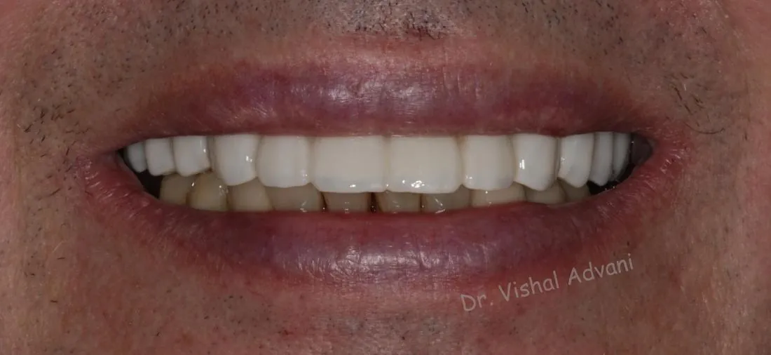 After: All-on-5 Upper Implants