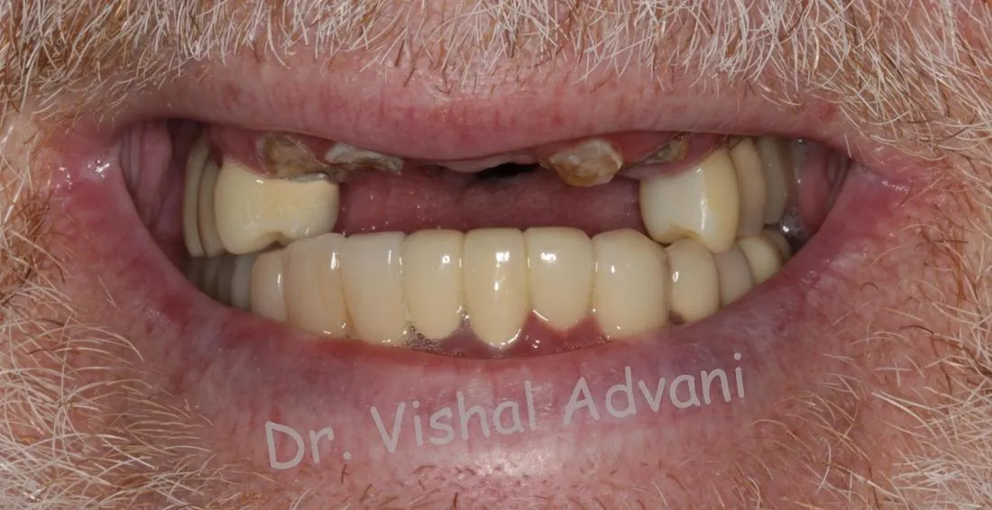 Before: Broken Front Teeth Replaced with Implants
