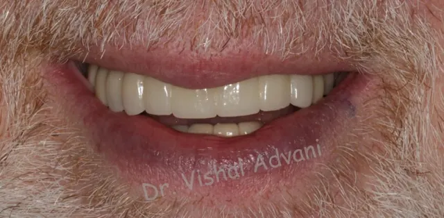 After: Broken Front Teeth Replaced with Implants