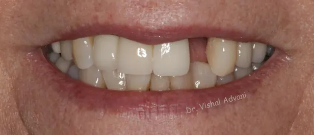 Before: Broken Front Tooth Replaced with an Implant