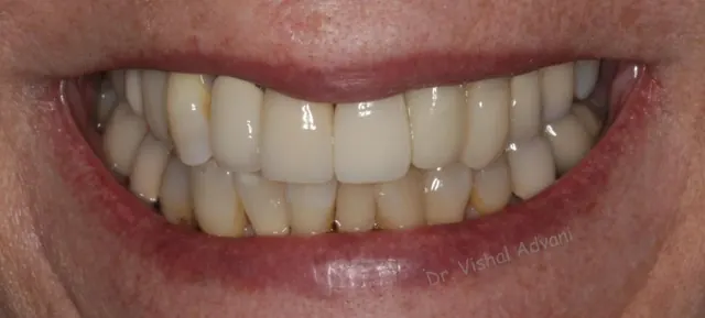 After: Broken Front Tooth Replaced with an Implant