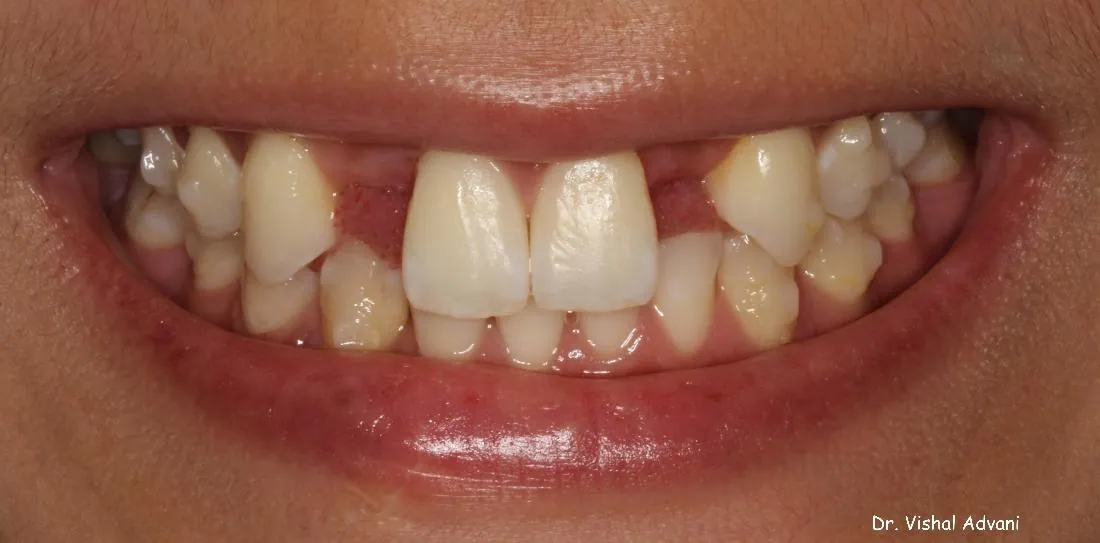 Before: Congenitally Missing Front Teeth