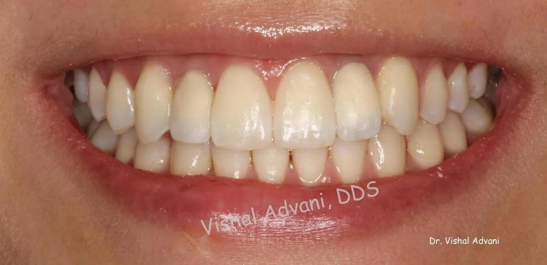After: Congenitally Missing Front Teeth