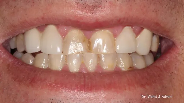 Before: Same-Day Crowns for Dark, Chipped Teeth