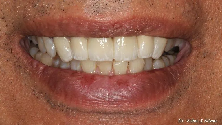After: Front Bridge & Veneers