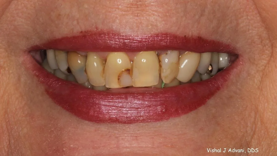 Before: Front Crowns to Improve Cosmetics