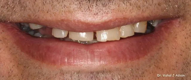Before: Front Tooth Replaced with Implant & Crown