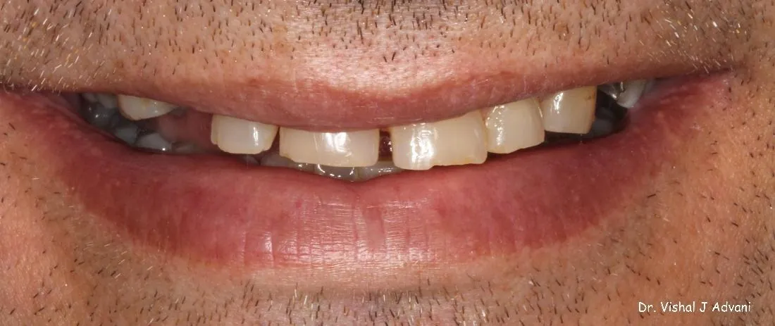 Before: Front Tooth Replaced with Implant & Crown