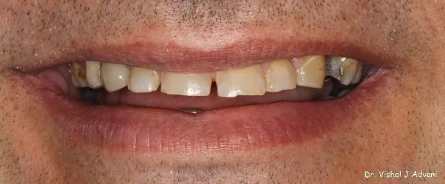After: Front Tooth Replaced with Implant & Crown