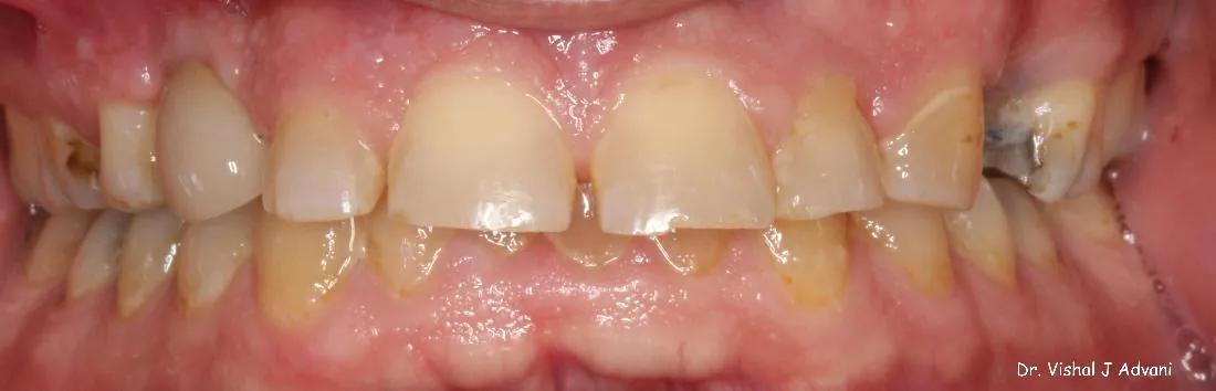 After: Front Tooth Replaced with Implant & Crown
