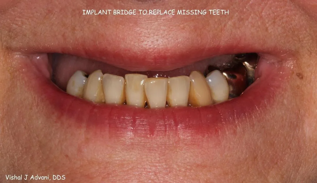 Before: Implant Bridge for Missing Upper Teeth