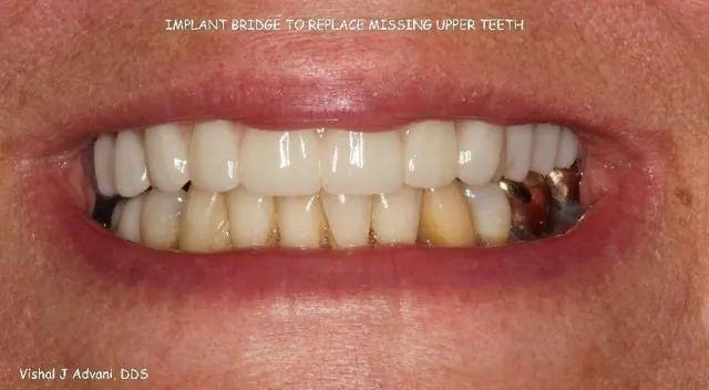 After: Implant Bridge for Missing Upper Teeth