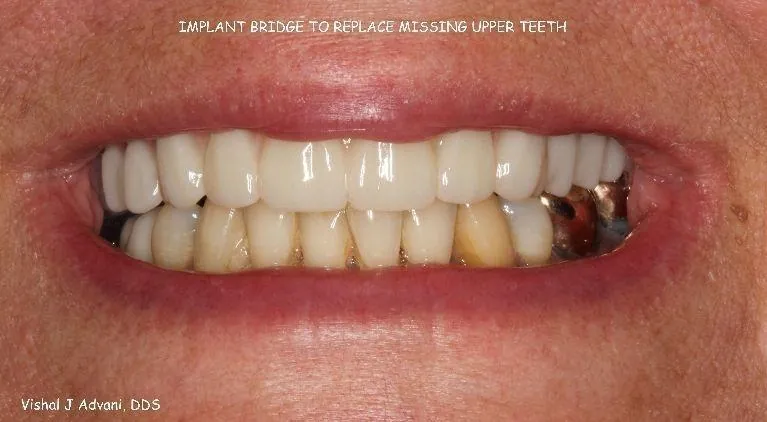 After: Implant Bridge for Missing Upper Teeth