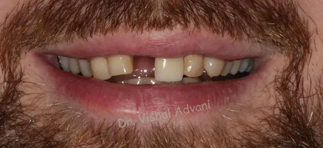 Before: Implant for a Broken Front Tooth