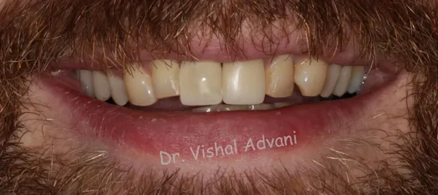After: Implant for a Broken Front Tooth