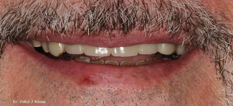 After: Implants & Cosmetic Bridge
