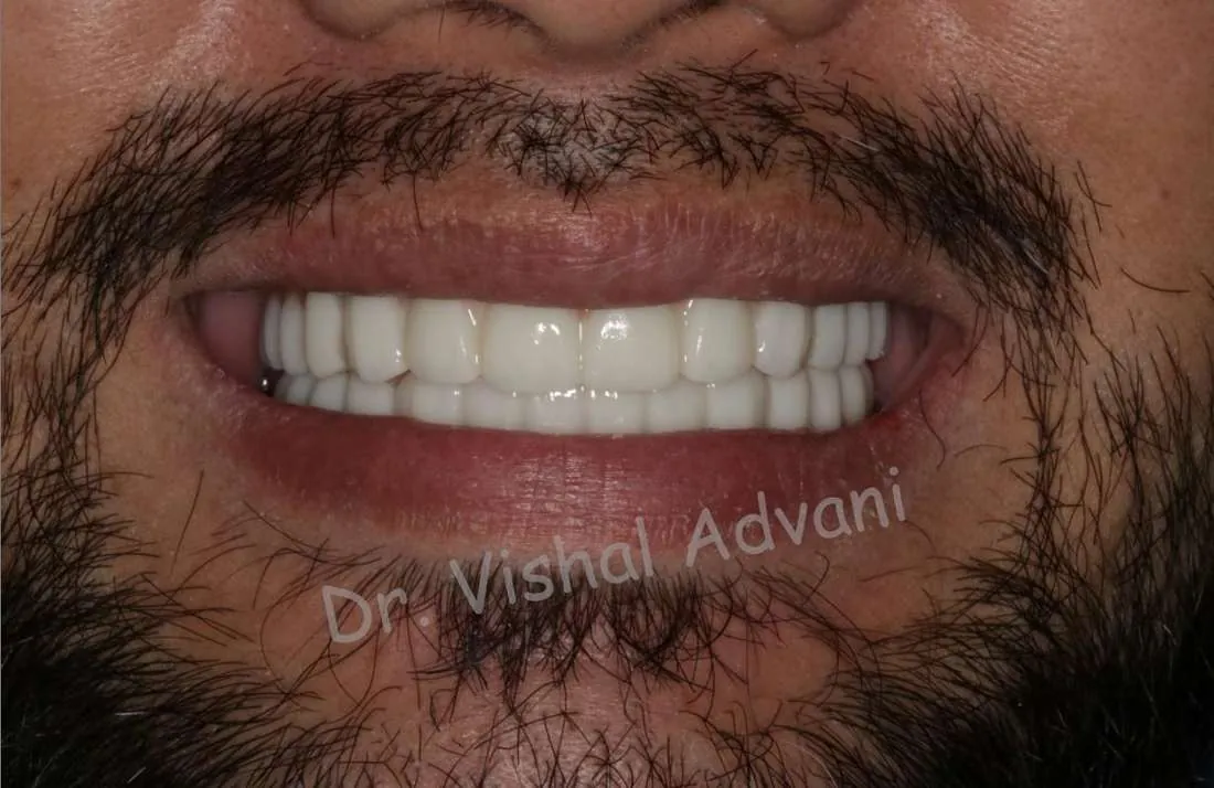 After: Full-Mouth Transformation with Implants
