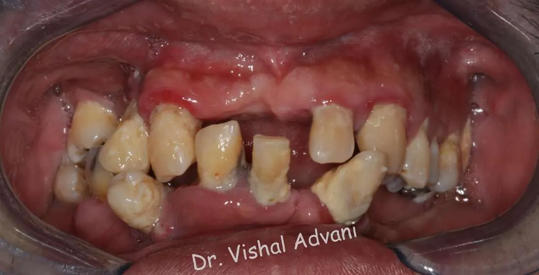 Before: Full-Mouth Transformation with Implants