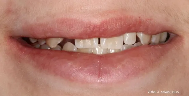 Before: Missing Adult Tooth Replaced with an Implant