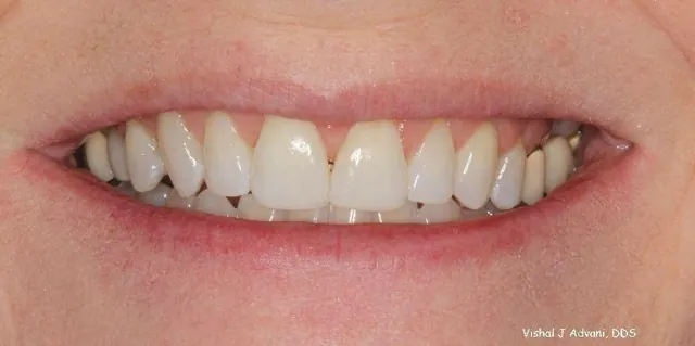 After: Short-Term Orthodontics (4.5 Months)