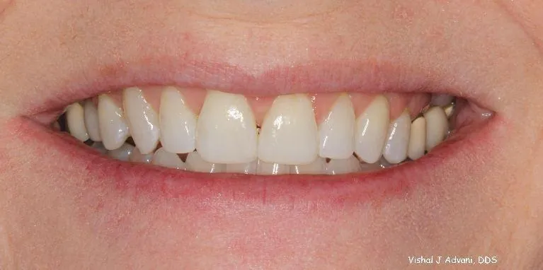 After: Short-Term Orthodontics (4.5 Months)