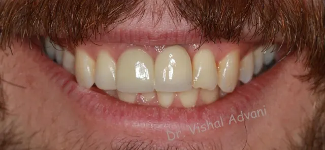 After: New Crown to Replace an Old, Dark Crown