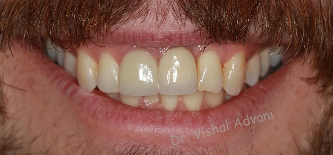 After: New Crown to Replace an Old, Dark Crown