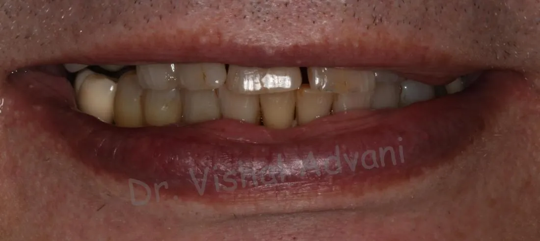 Before: Teeth-in-a-Day (All-on-4)