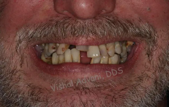 Before: Upper & Lower All-on-4