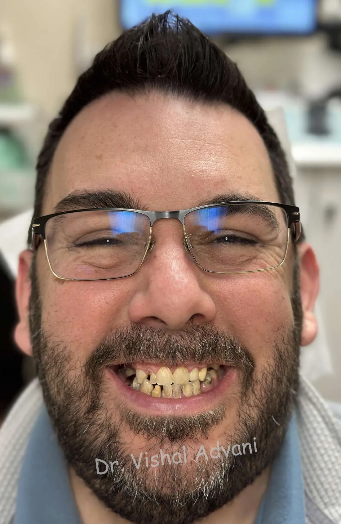 Before: Upper & Lower All-on-X