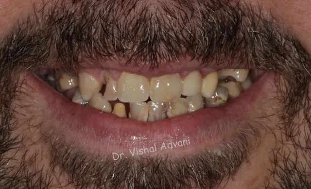 Before: Upper & Lower All-on-X