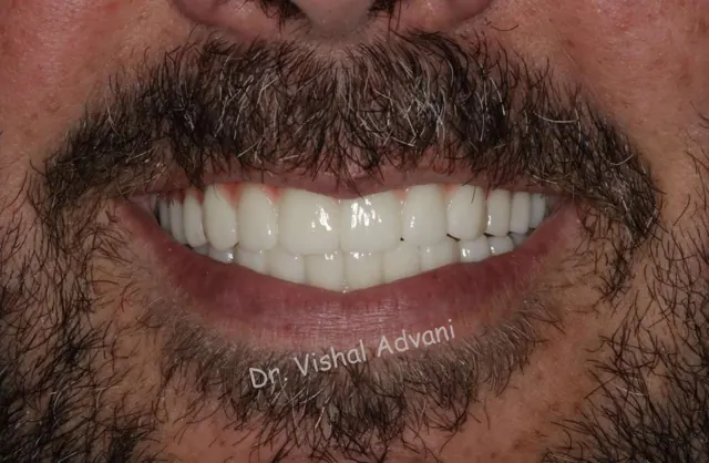 After: Upper & Lower All-on-X