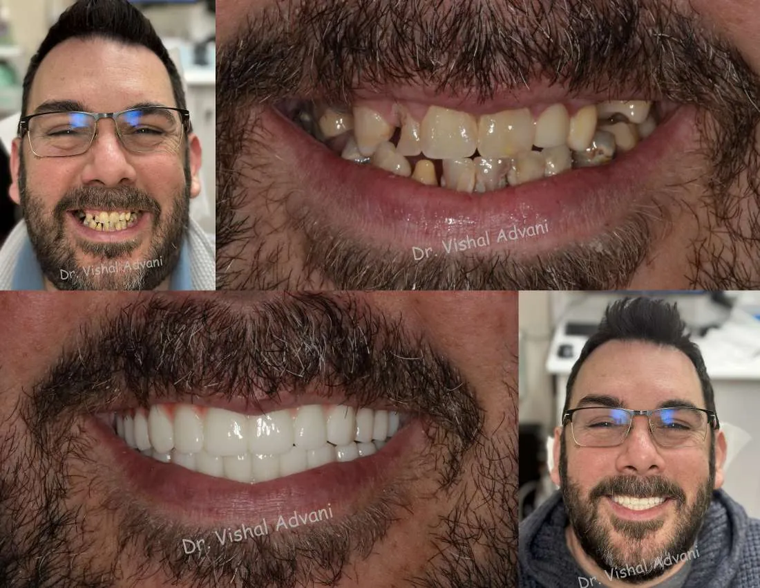 After: Upper & Lower All-on-X