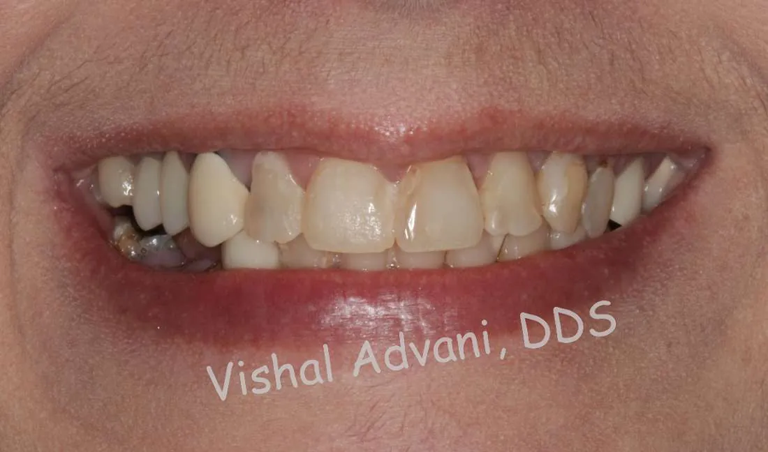 Before: Upper & Lower All-on-X Bridges