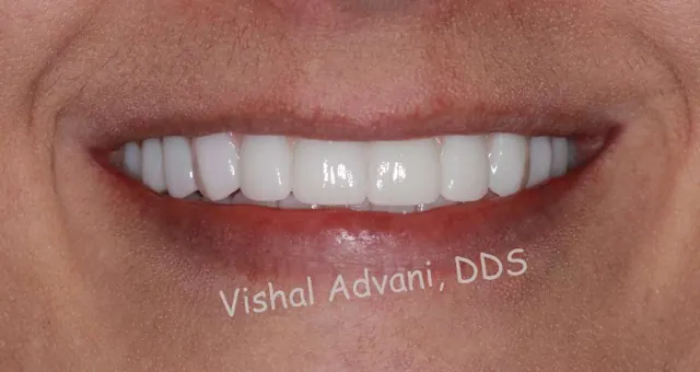 After: Upper & Lower All-on-X Bridges
