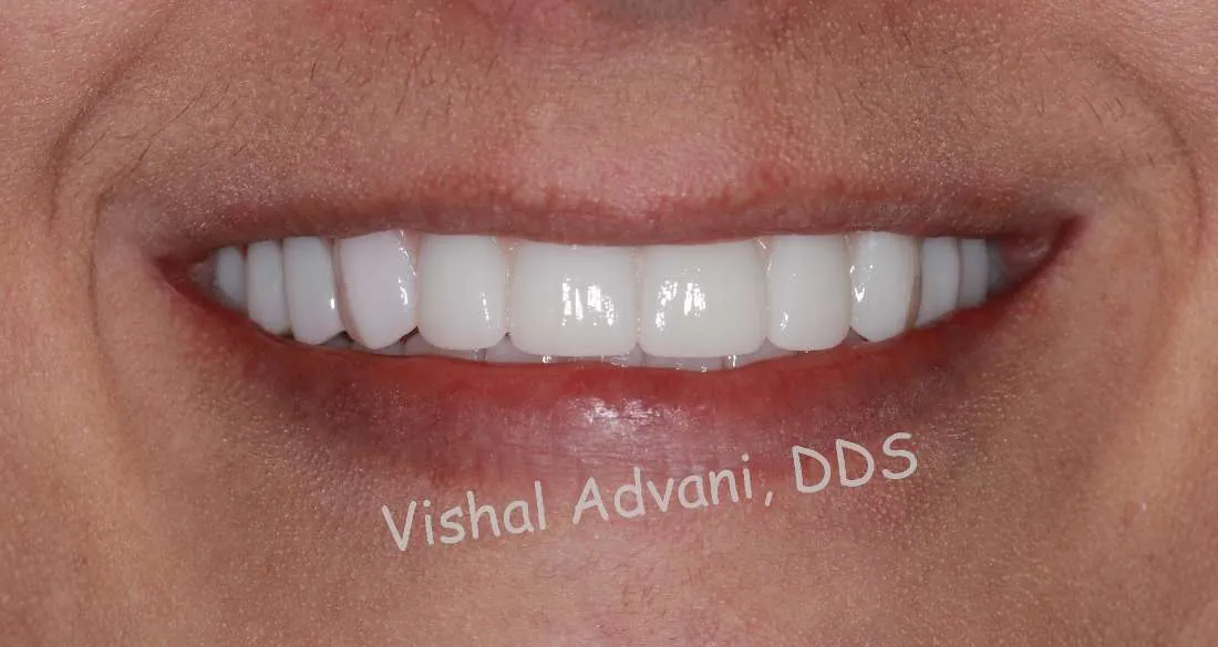 After: Upper & Lower All-on-X Bridges