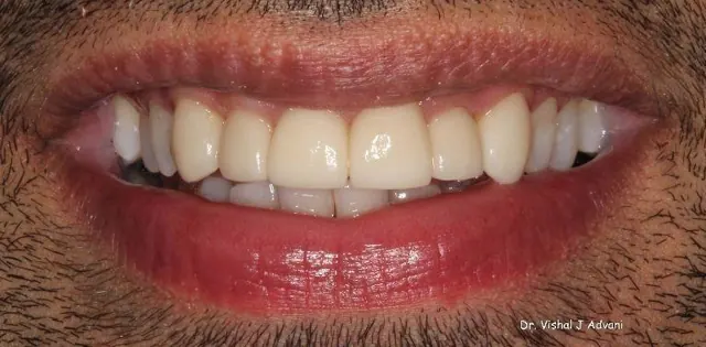 After: Veneers on Upper Front Teeth