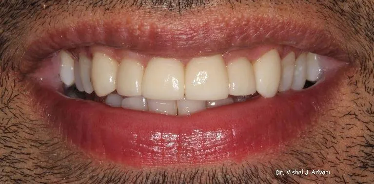 After: Veneers on Upper Front Teeth
