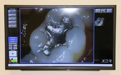 Intraoral camera image displayed on a screen