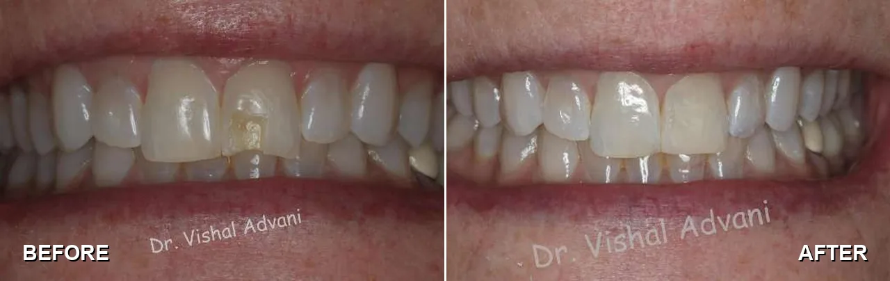 Before and after: cosmetic bonding to fix a broken tooth