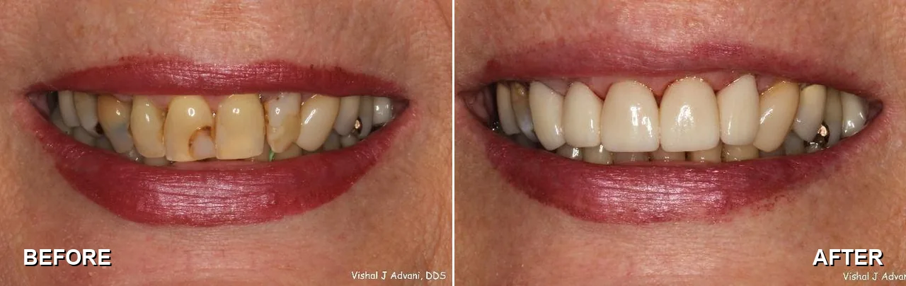 Before and after: front crowns to improve cosmetics